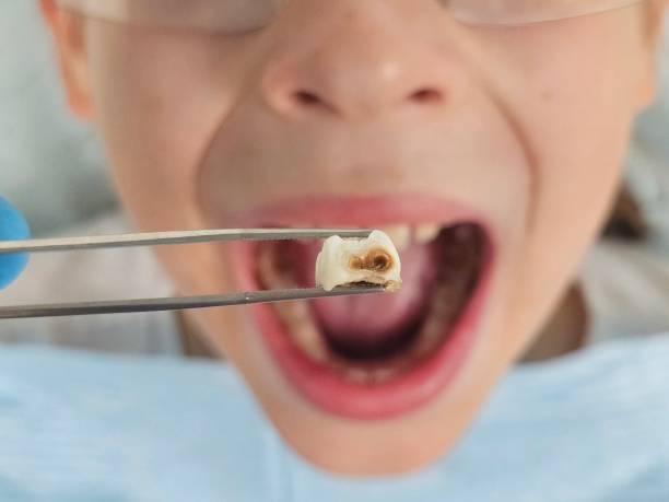 Best Emergency Wisdom Teeth Removal in Cornell, WI